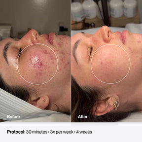 Celluma FACE